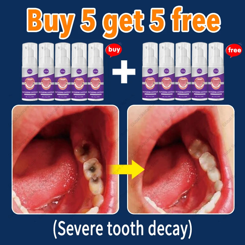 decay Tooth Repair Repairing Cavities Protect Anti caries