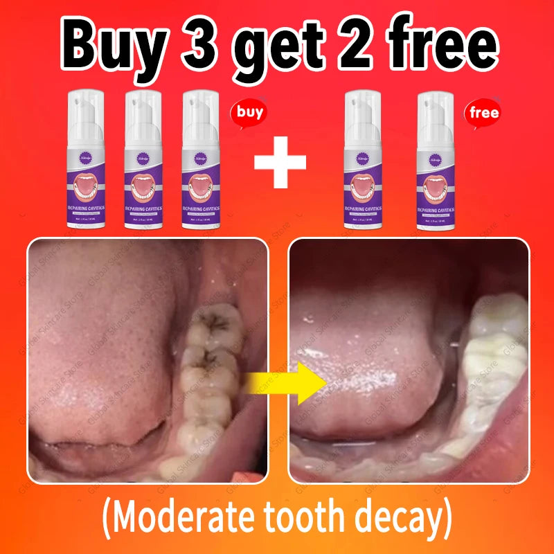 decay Tooth Repair Repairing Cavities Protect Anti caries