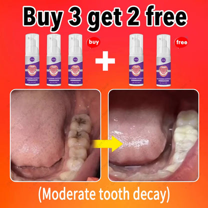 decay Tooth Repair Repairing Cavities Protect Anti caries