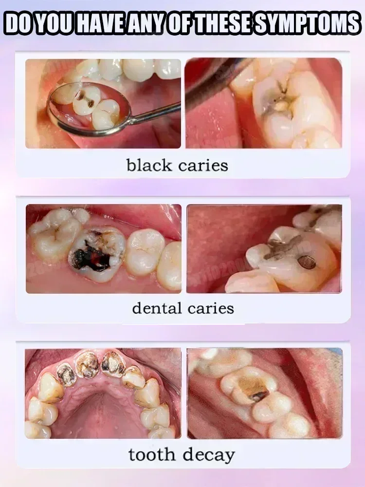 2025 Reparación de caries, todas las caries, caries y protegen los dientes Corrección del color