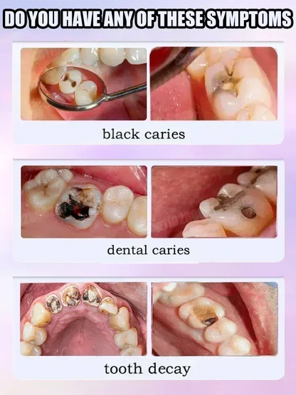 2025 Reparación de caries, todas las caries, caries y protegen los dientes Corrección del color