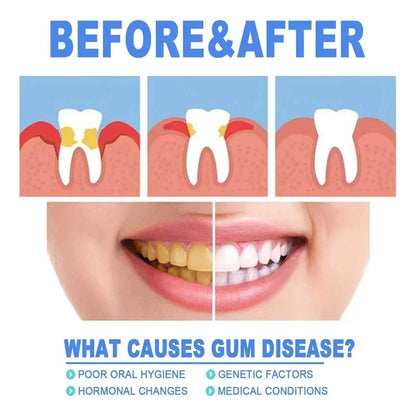 Suero Reparador Rápido para Encías, Alivia Efectivamente la Sensibilidad Dental, Caries, Limpieza Dental, Pasta Dental, Gotas para Aliviar el Daño Dental