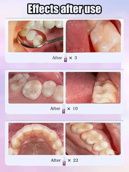 2025 Reparación de caries, todas las caries, caries y protegen los dientes Corrección del color